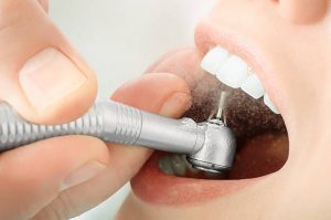 LImpieza dental