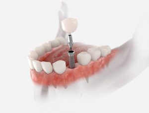implante dental
