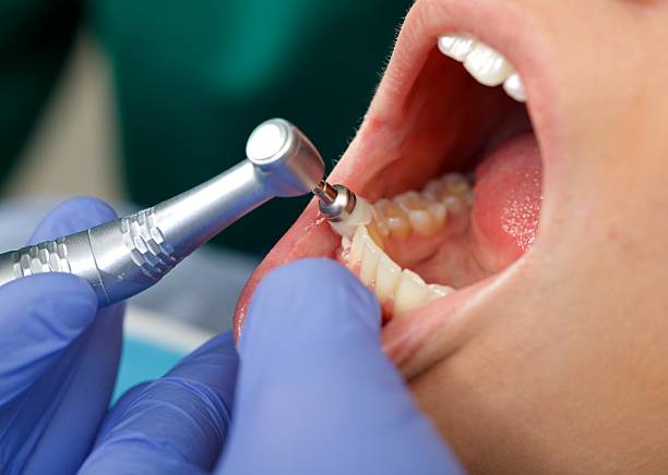 Limpieza de dientes en Tenerife