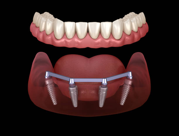 implantes dentales all on four tenerife