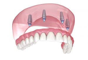 Implantes dentales all on 4