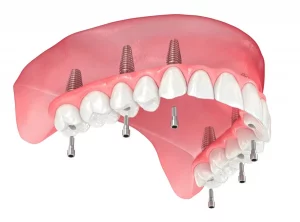 implantes dentales all on 6