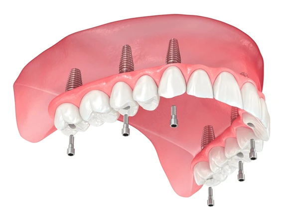 implantes dentales all on 6