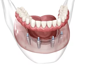 implantes dentales all on four