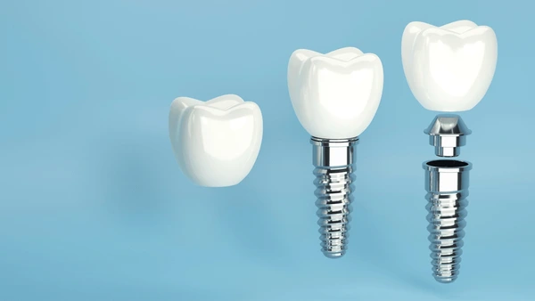Implantes dentales con tornillos
