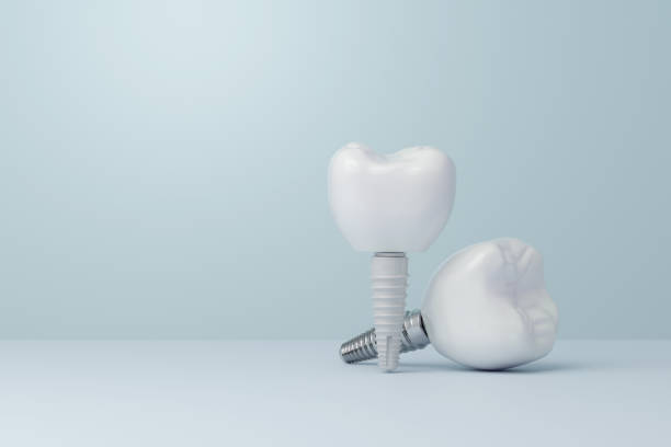 Implantes dentales de zirconio