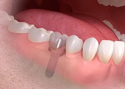 Implantes Dentales Bifásicos