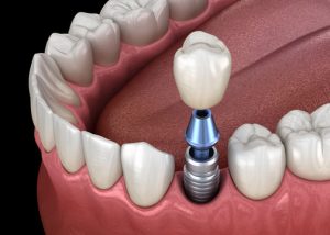 Coronas sobre Implantes Dentales