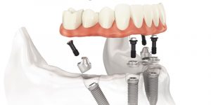 Prótesis sobre Implantes Dentales