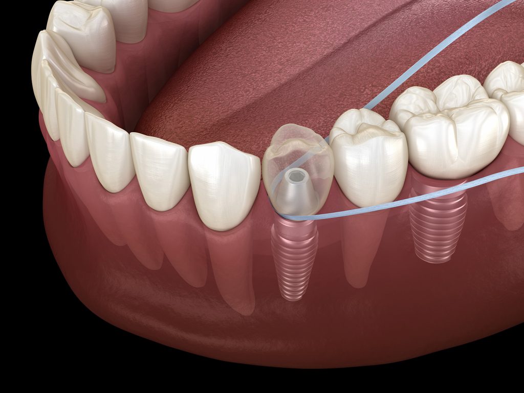 limpieza de implantes dentales
