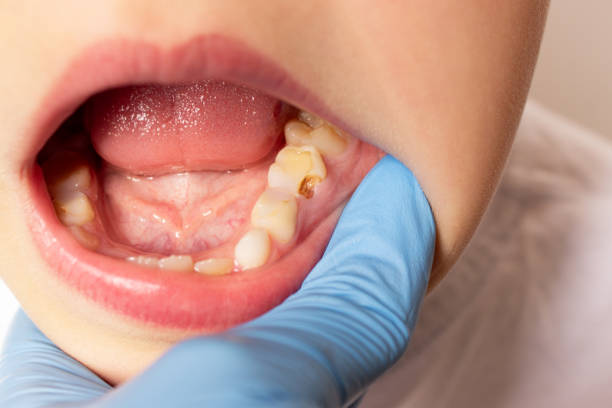 Caries en dientes de leche