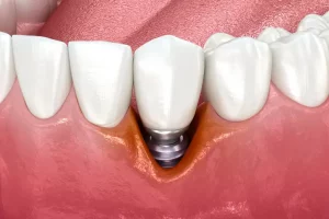 Periimplantitis