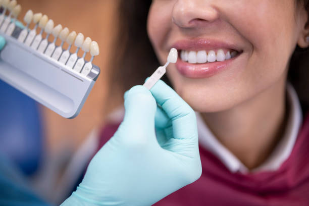 Carillas Dentales de Porcelana