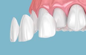 carillas dentales de composite