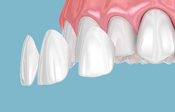 carillas dentales de composite
