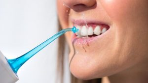 Como limpiar las carillas dentales