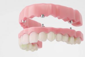 Prótesis dental