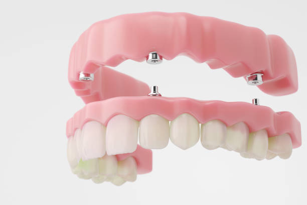 Prótesis dental