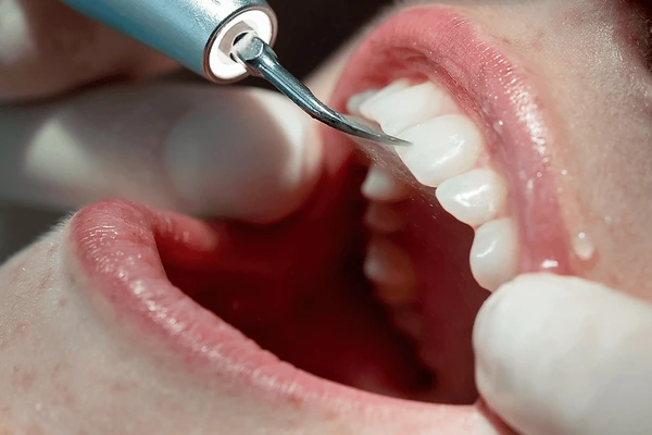 profilaxis dental